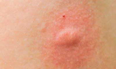 mosquito picadura