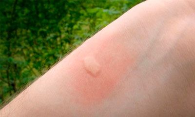 mosquito piel