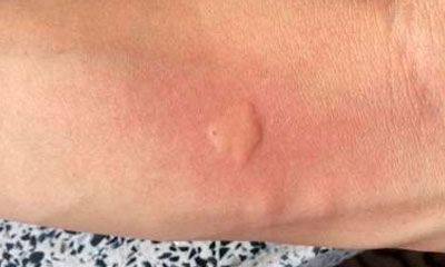 mosquito roncha
