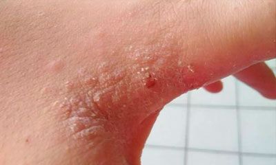 sarna mano