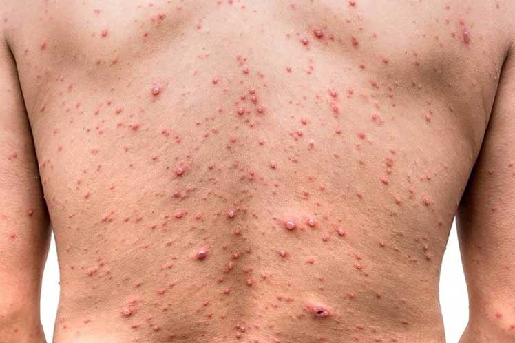 mpox