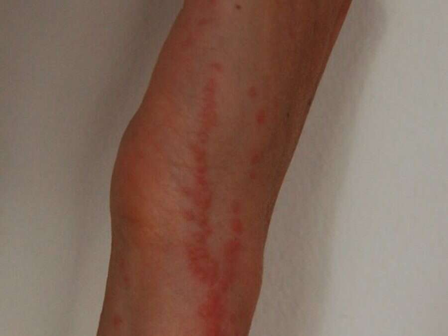 Picaduras reales de chinche alineadas en hilera sobre un brazo
