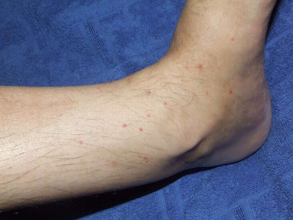 Picaduras de pulga agrupadas en el tobillo y la parte baja de la pierna